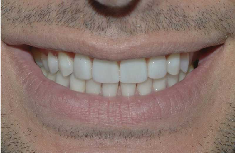 faccette dentali senza limare i denti
