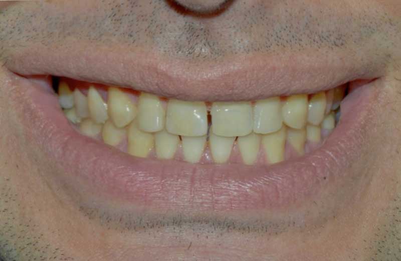 colore-denti-prima-delle-faccette