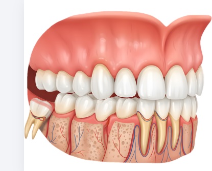 Riassorbimento osseo dentale dopo estrazione