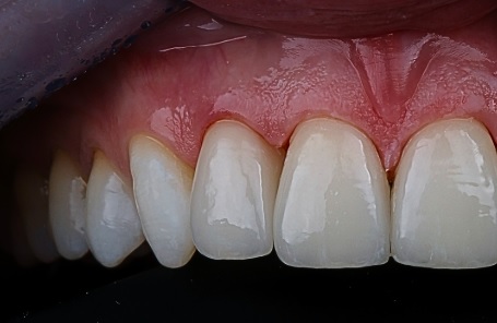 macchie bianche sui denti dopo l'apparecchio