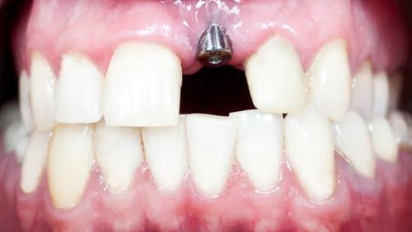 impianto dentale dopo estrazione