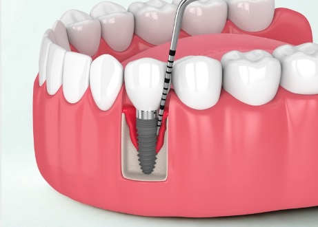 mucosite perimplantare
