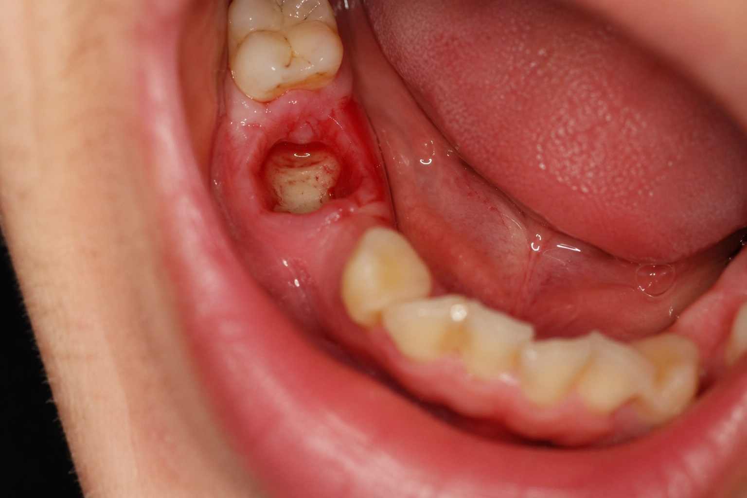 alveolite dentale
