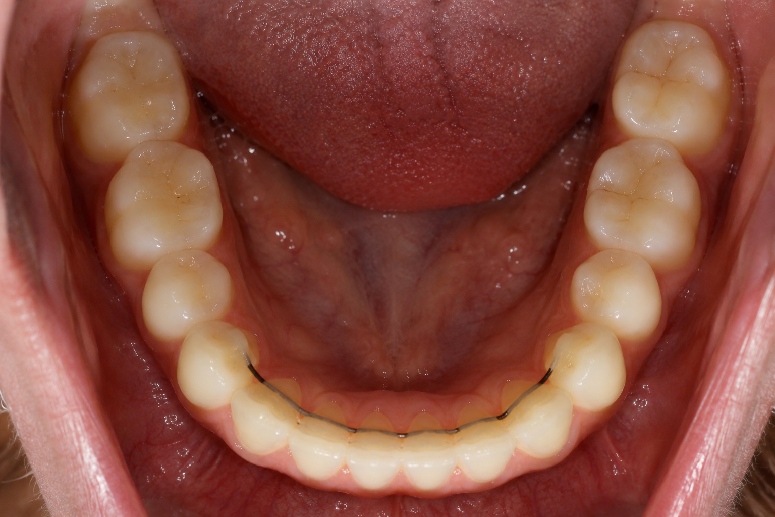 denti storti dopo apparecchio