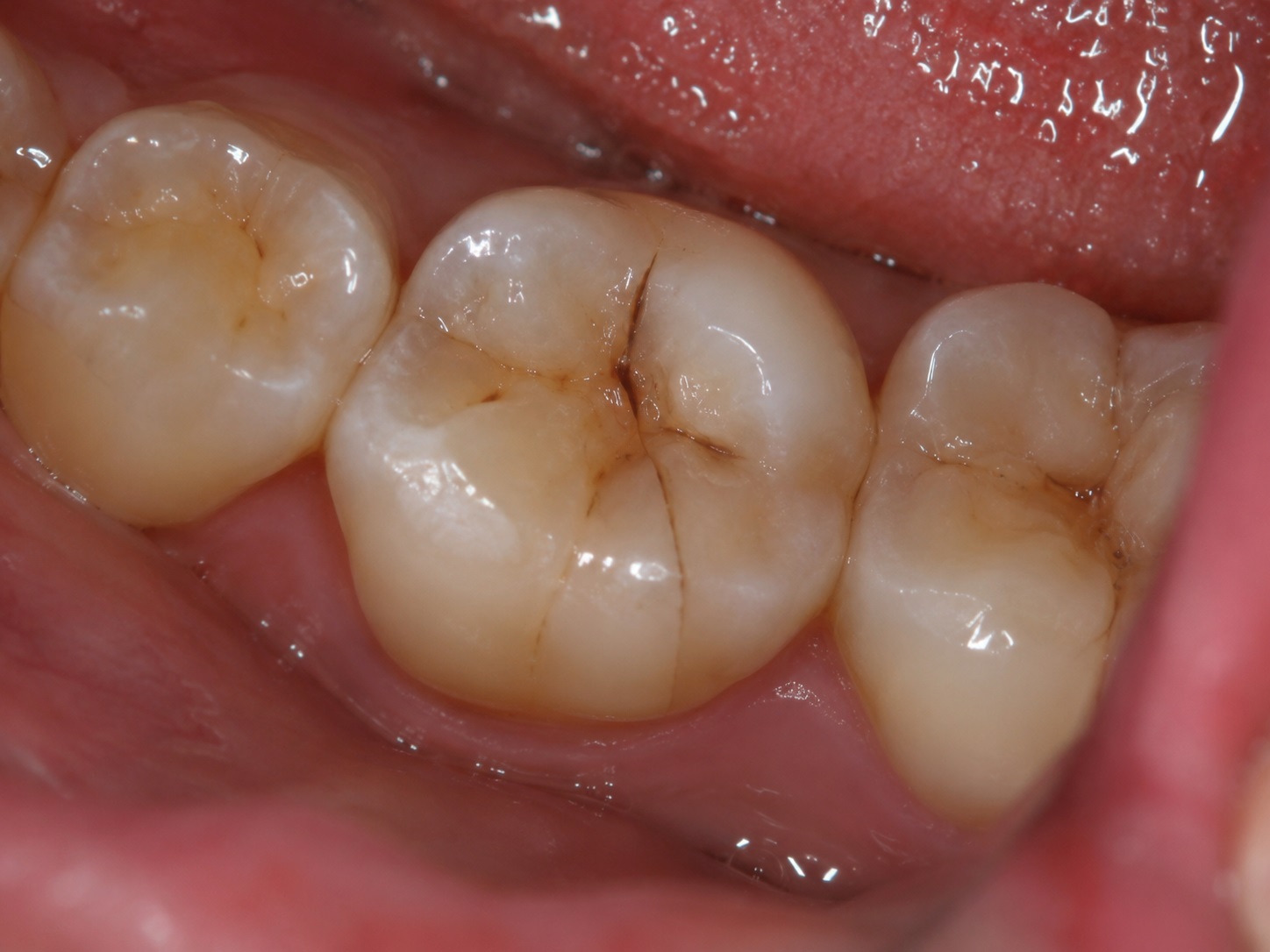 dente incrinato