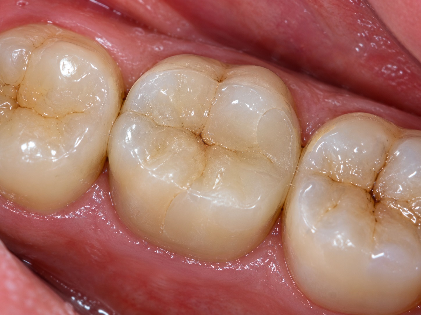 intarsio dentale